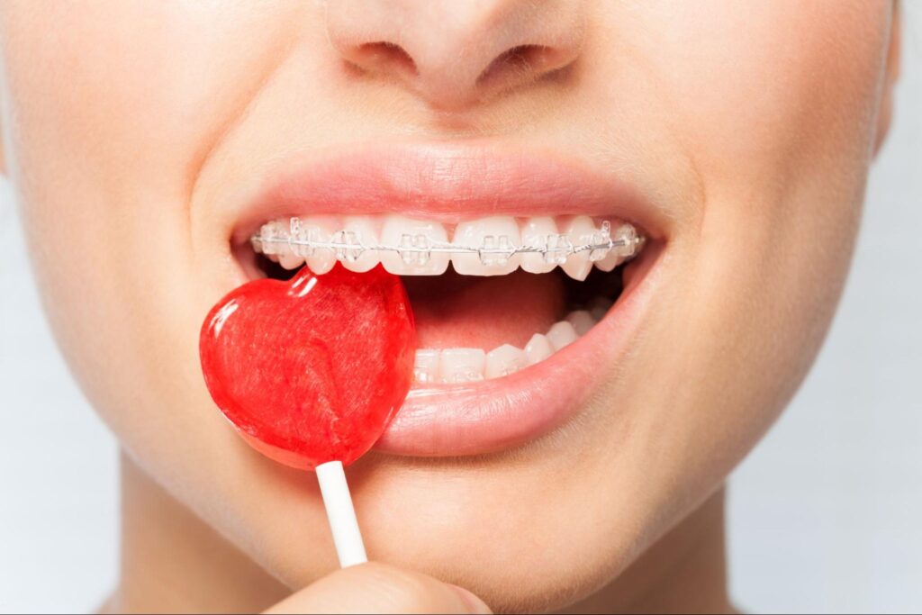 Foods To Avoid With Braces